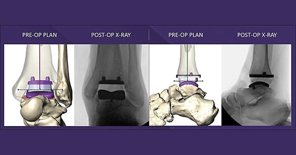 Paragon 28 MAVEN PSI Surgical Planning