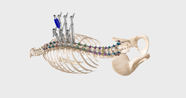 SpineCraft ASTRA Spine Deformity System