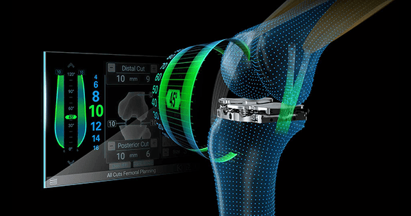 Exactech Newton Soft Tissue Management