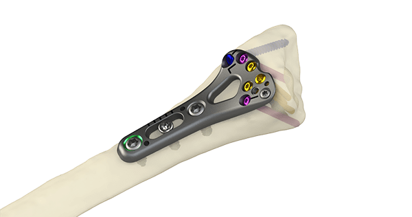 The Orthopaedic Implant Company DRPx Wrist Plate