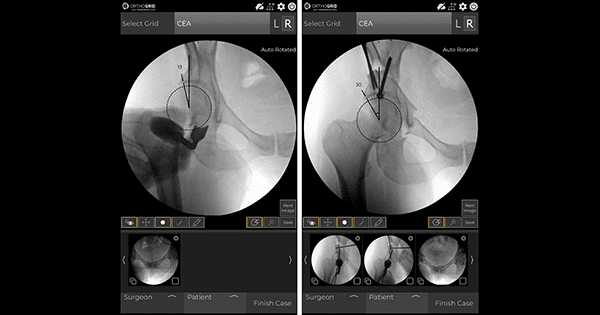 OrthoGrid Hip Preservation