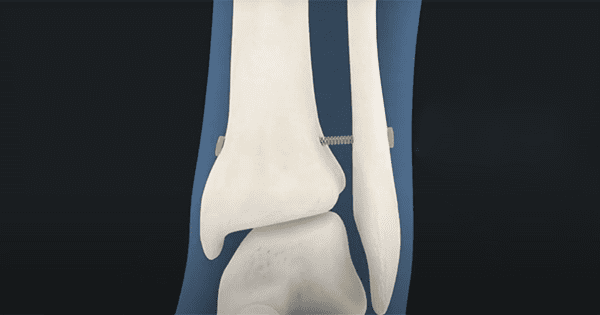 Panther Orthopedics PUMA System