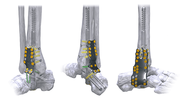 Paragon 28 Silverback Straddle Plating