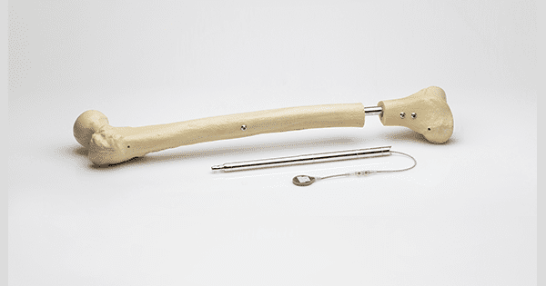 Orthofix Medical FITBONE Limb Lengthening System