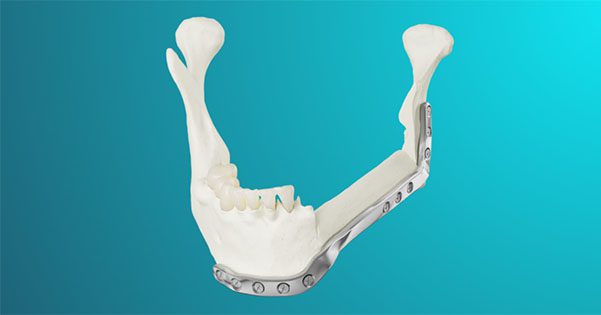 MedCAD AccuPlate System