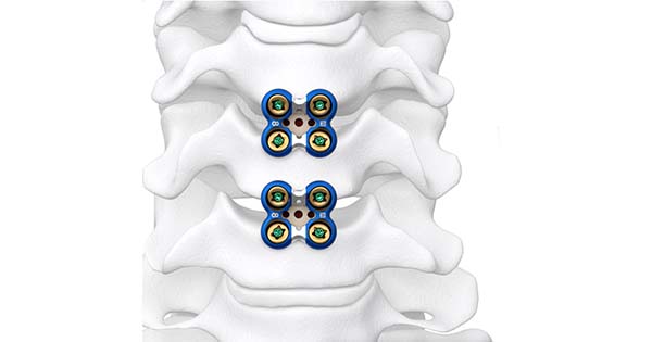 Spinal Elements Sapphire X