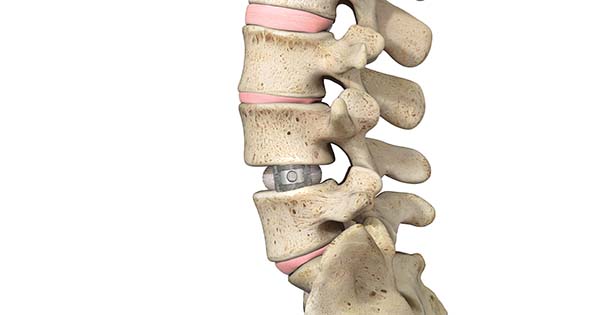 Spineology DuoTi