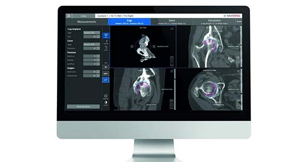 Naviswiss Naviplan Hip Replacement Pre-op Planning