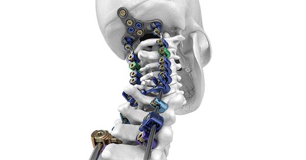 SeaSpine NorthStar OCT Posterior Cervical Fixation