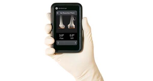 We spoke with OrthAlign's Eric Timko about technology trends, Lantern ASC and company's move into the European market.