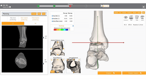 3D-Side Customize Ankle Pre-Operative Planning Software