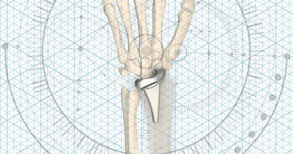 Extremity Medical KinematX Wrist Implant