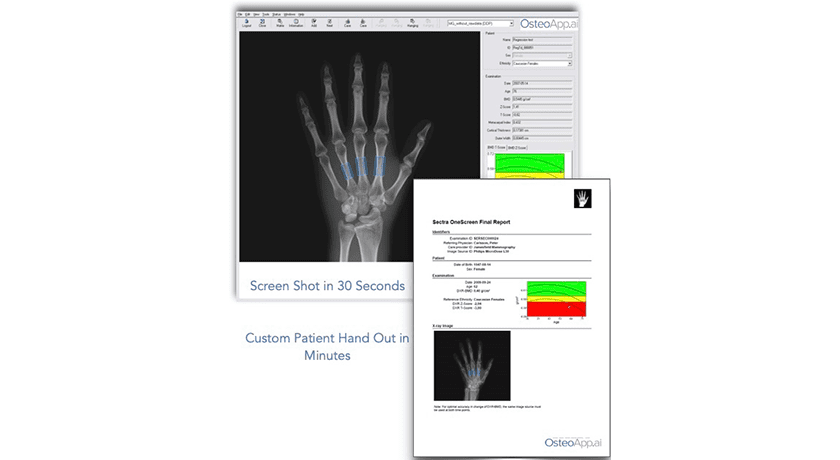 OsteoApp.ai OsteoApp.ai Developing AI-Driven Bone Health Assessment