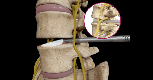 Spineology OptiLIF Endo