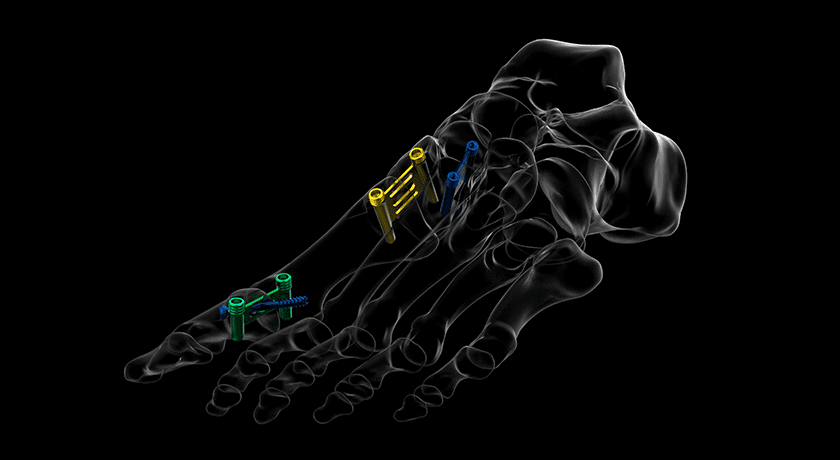 Medartis StealthFix Intraosseous Fixation System