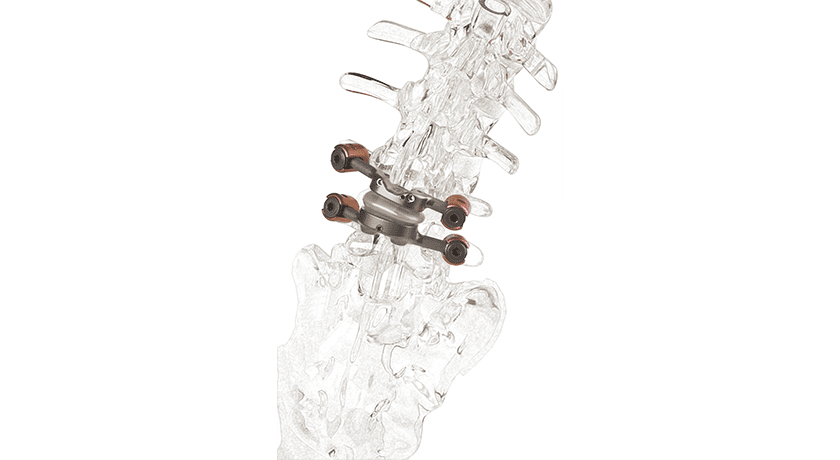 Premia Spine TOPS Facet Joint Replacement