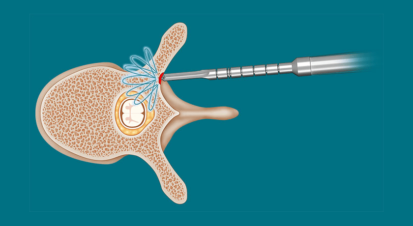 SpineGuard DSG Procedure