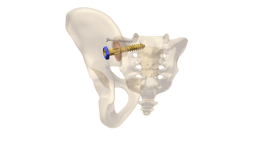 OsteoCentric Technologies Integrity-SI