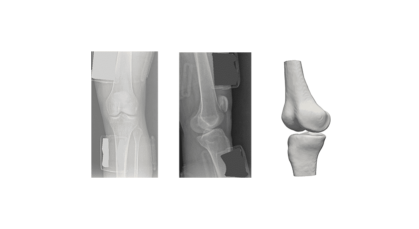 RSIP Vision 3D Knee Bones Reconstruction