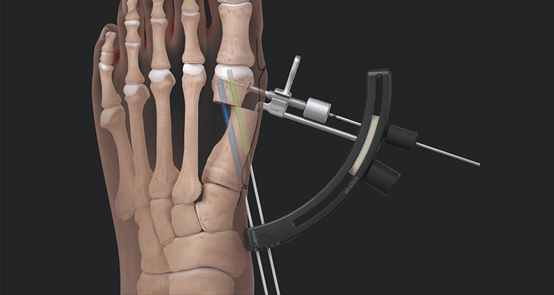 Arthrex Minimally Invasive Bunionectomy System