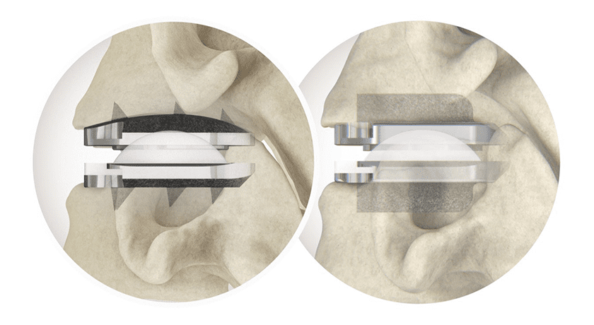 Centinel Spine prodisc C Vivo & prodisc C SK