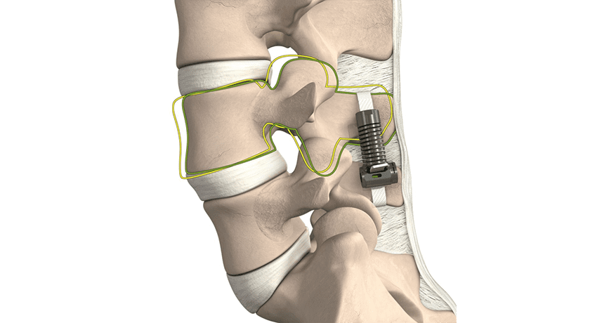 Empirical Spine Limiflex Dynamic Sagittal Tether