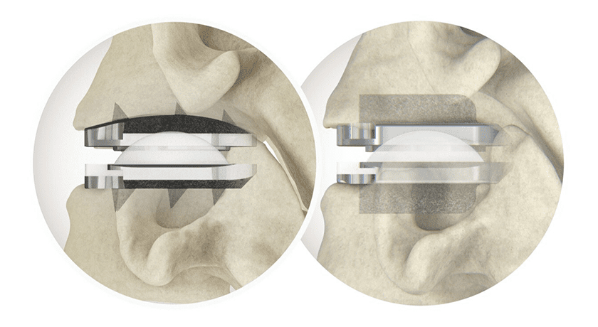 Centinel Spine prodisc C Vivo and prodisc C SK