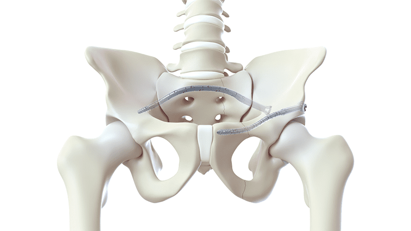 CurvaFix Smaller Diameter CurvaFix IM Implant