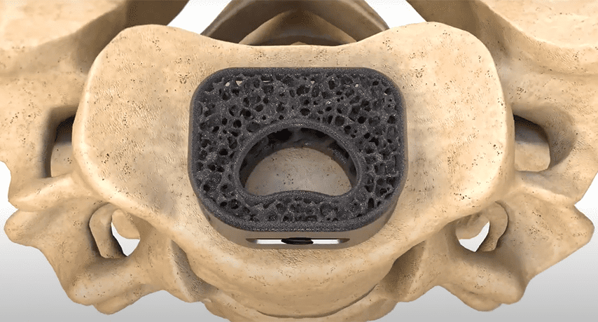 NuVasive Modulus Cervical Interbody