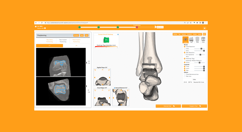 Smith+Nephew TOTAL ANKLE Interactive Software