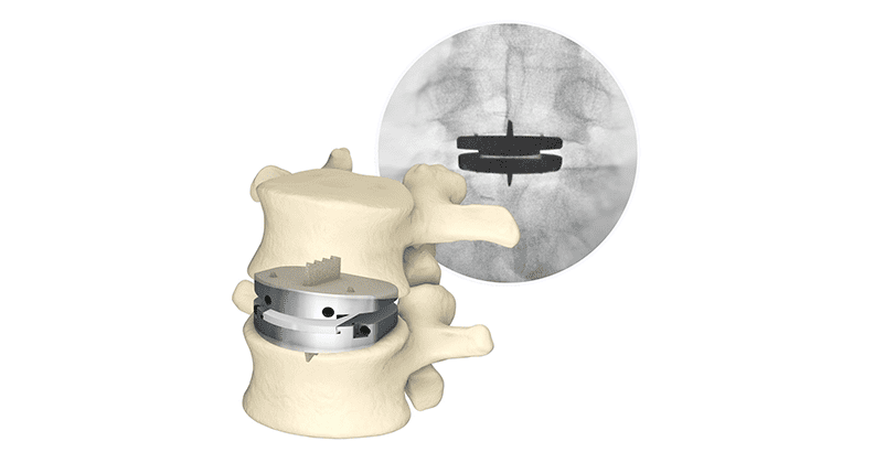 Centinel Spine prodisc-L Total Disc Replacement