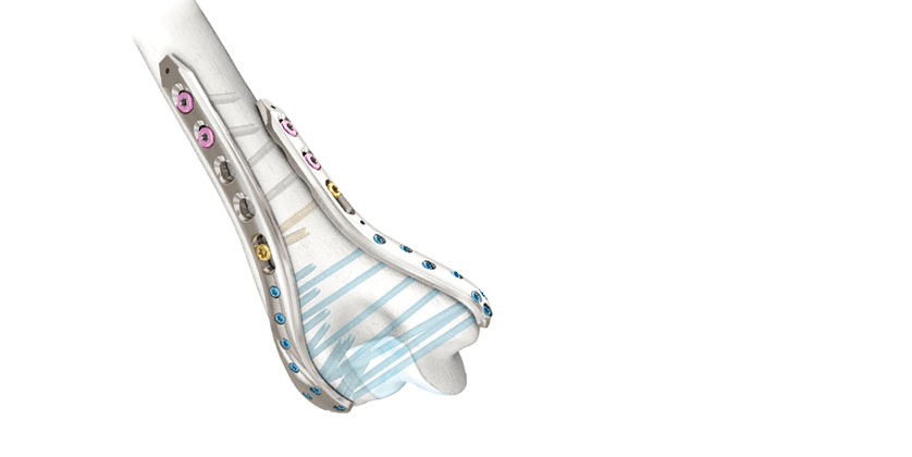 aap Implantate LOQTEC VA Elbow Plating