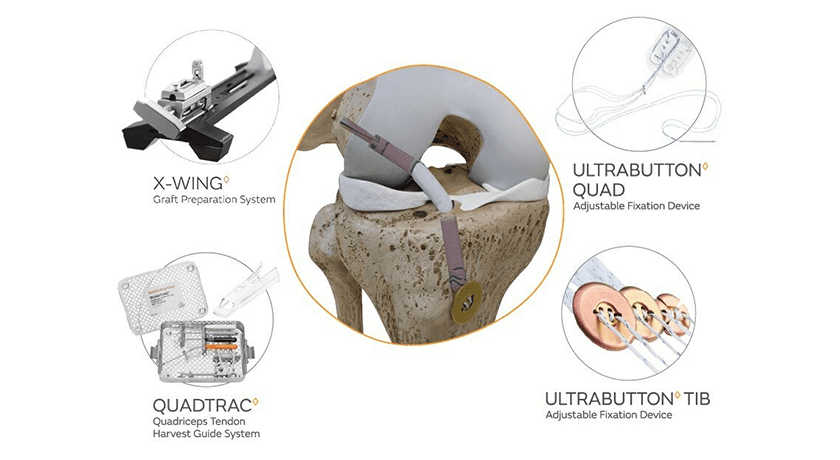 Smith+Nephew UltraTRAC QUAD ACL Reconstruction