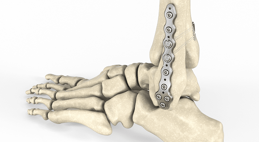 Enovis Enofix with Constrictor Technology