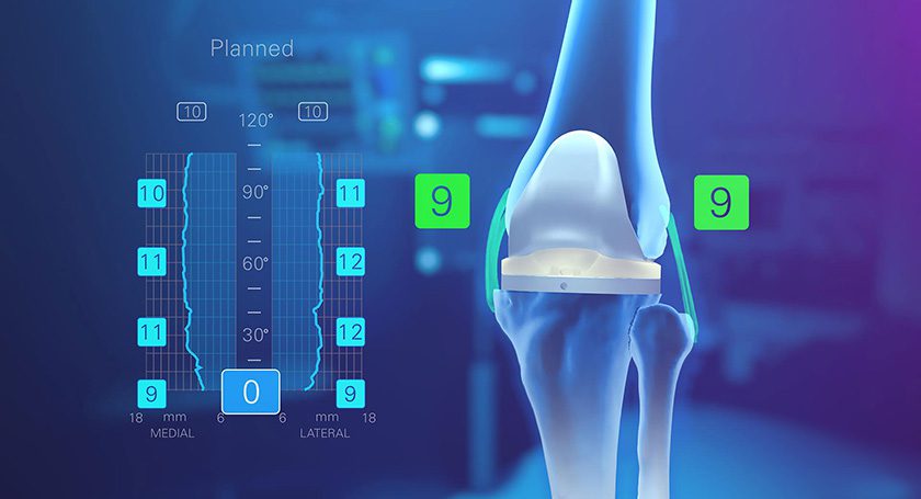 Exactech Newton Knee Balancing Technology