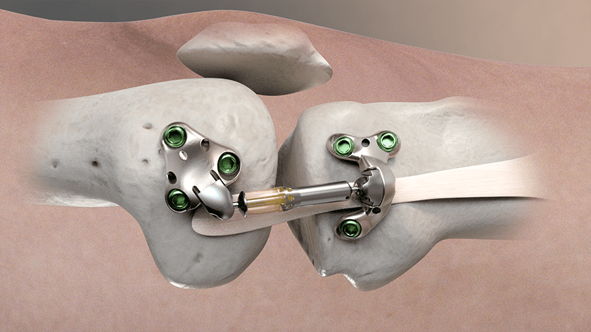 Moximed MISHA Knee Implant