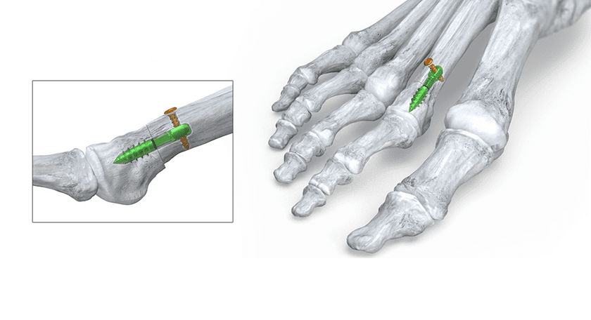 Paragon 28 Phantom Metatarsal Shortening System