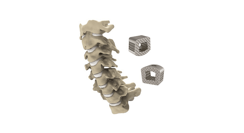 ZSFab Cervical Interbody System