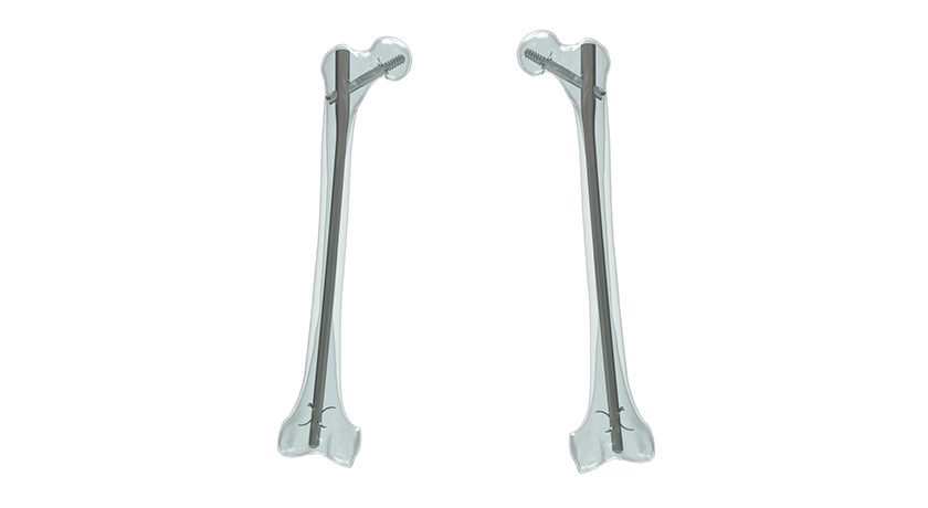 a Distal femoral nonunion after retrograde intramedullary nail of type... |  Download Scientific Diagram