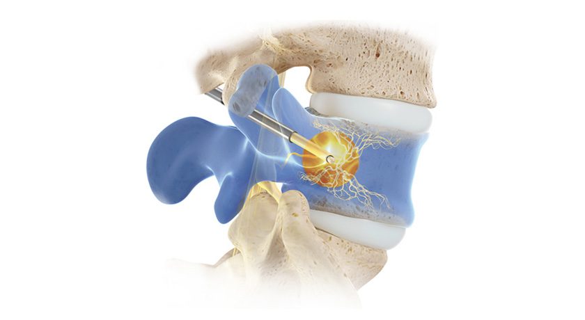 Relievant Medsystems Intracept Procedure