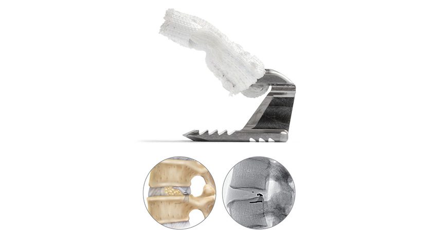 Intrinsic Therapeutics Barricaid Annular Closure