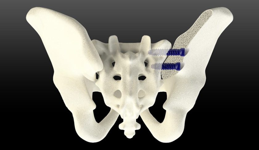 SurGenTec TiLink-L Sacroiliac Joint Fusion