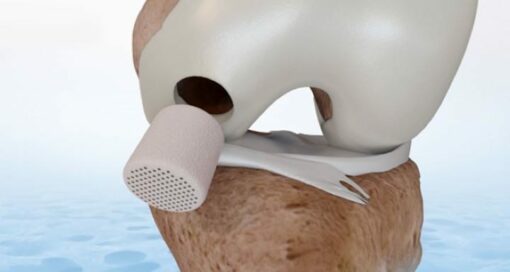 CartiHeal Agili-C Implant