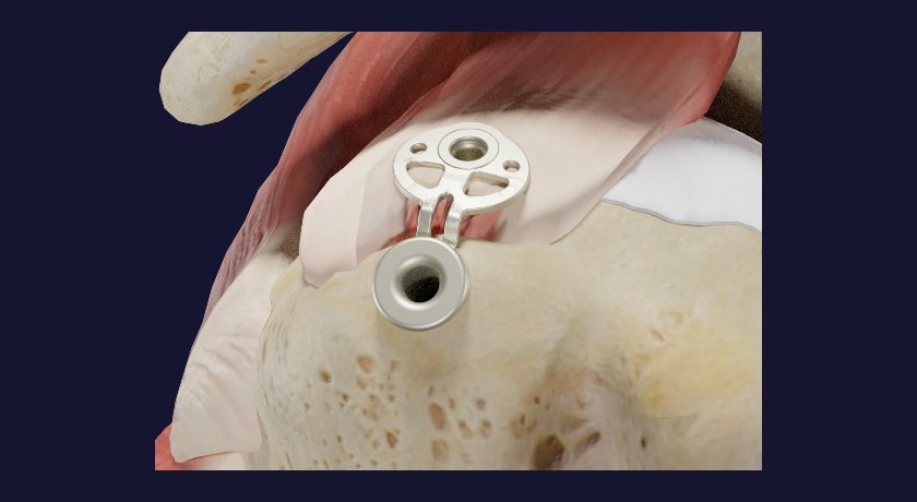 Inovedis SINEFIX Rotator Cuff Repair