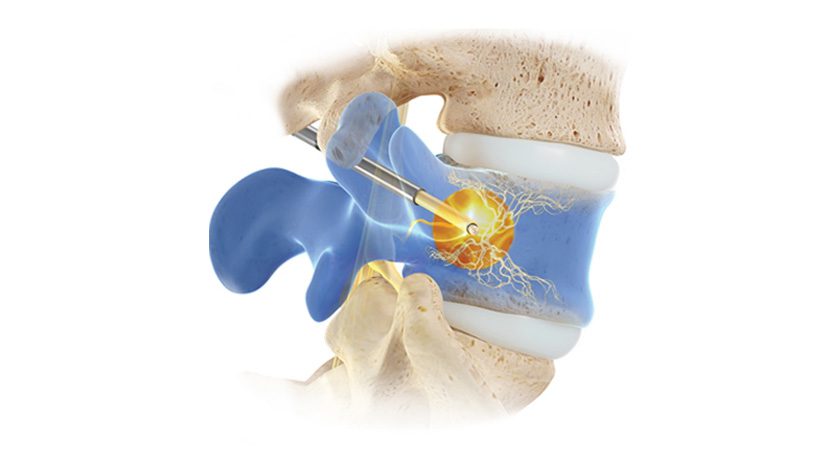 Relievant Medsystems Intracept Procedure