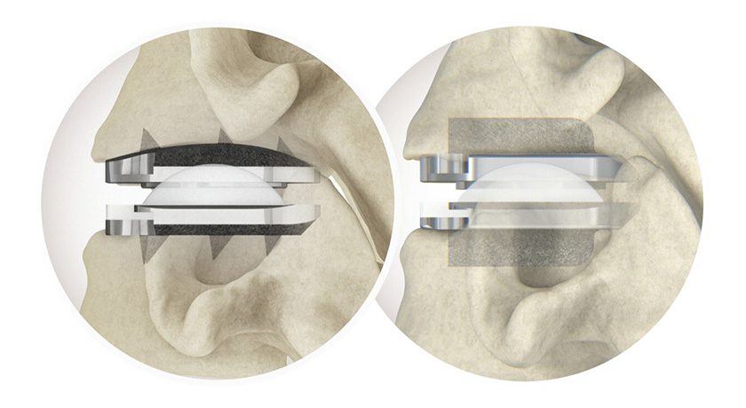 Centinel Spine prodisc C Vivo and prodisc C SK