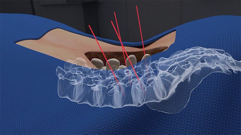 OnPoint Surgical Augmented Reality Spine System