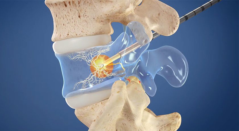 Relievant Medsystems Intracept Procedure