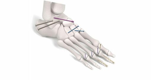 Trax Surgical TRAX Compression Screws
