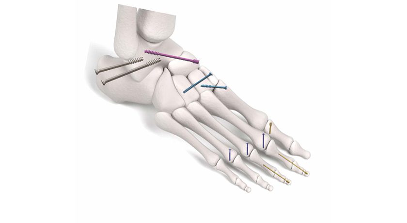 Trax Surgical TRAX Compression Screws